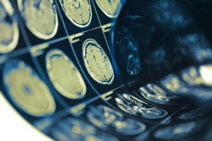 CT scans of brains